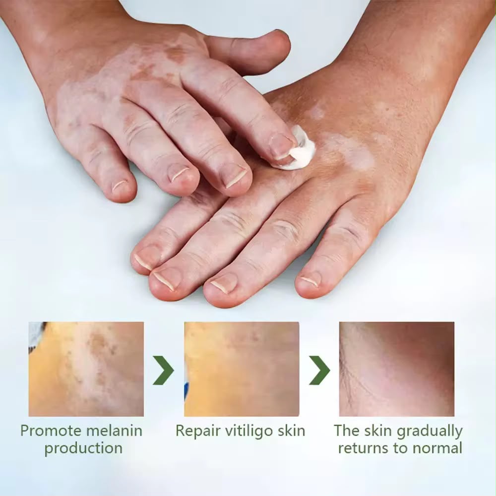 Sumifun Vitiligo Cream